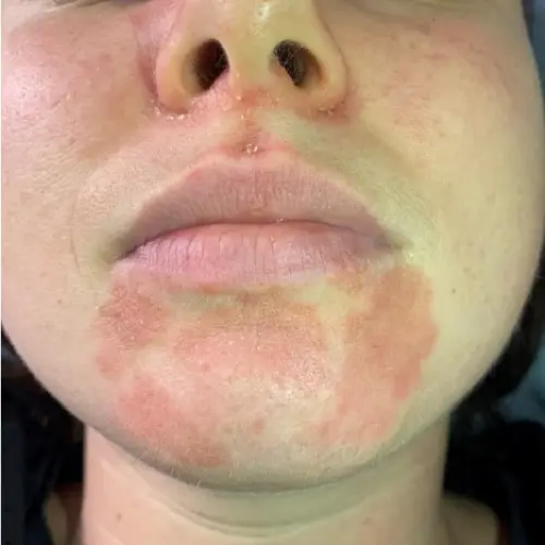 Before LED light therapy at The Vancouver Aesthetician — visible facial redness and inflammation on skin