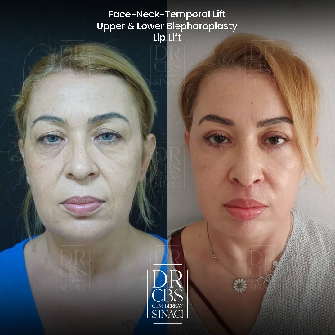 deep plane facelift and upper blepharoplasty 7 months post-op before after front view