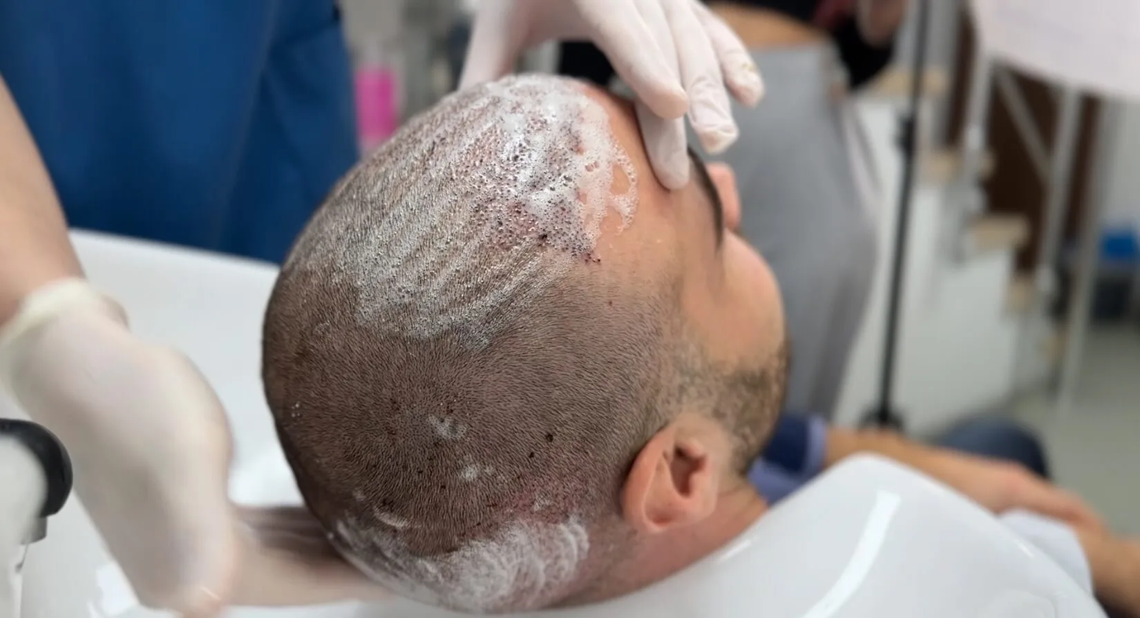 Gentle foam wash after 7 days of hair transplant