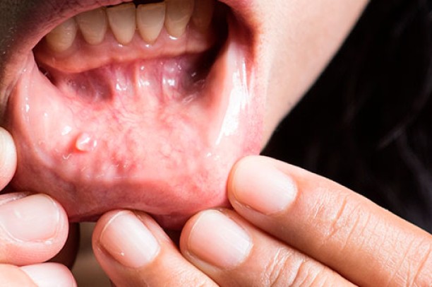 Tratamento de cistos e tumores em boca - Dr Bruno Gomes Bucomaxilo