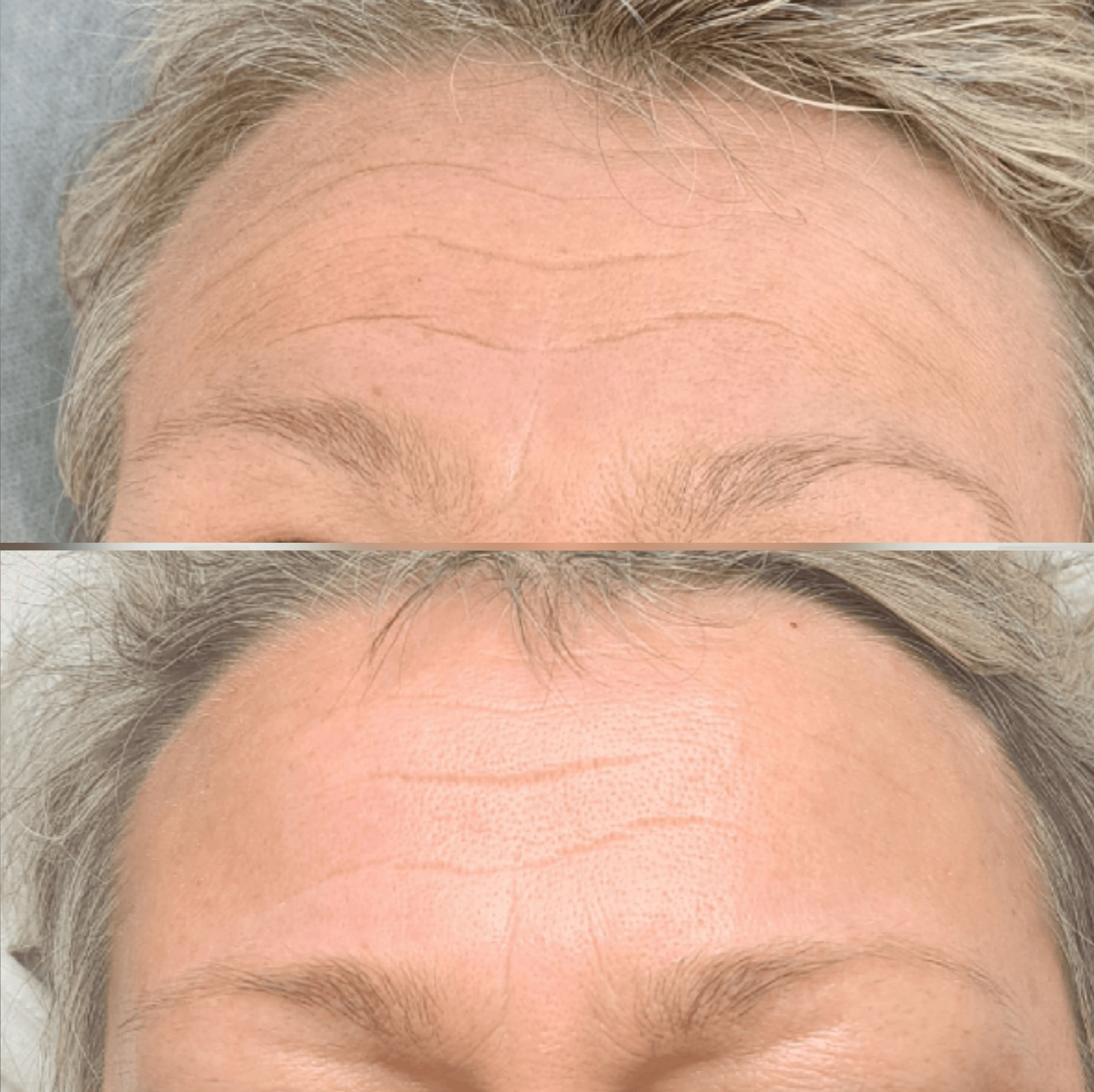 Neurolifting efekt_jednego_spotkania_szczecin_leszczenko_neurorehabilitacja_zabiegi_zamiast_botoksu