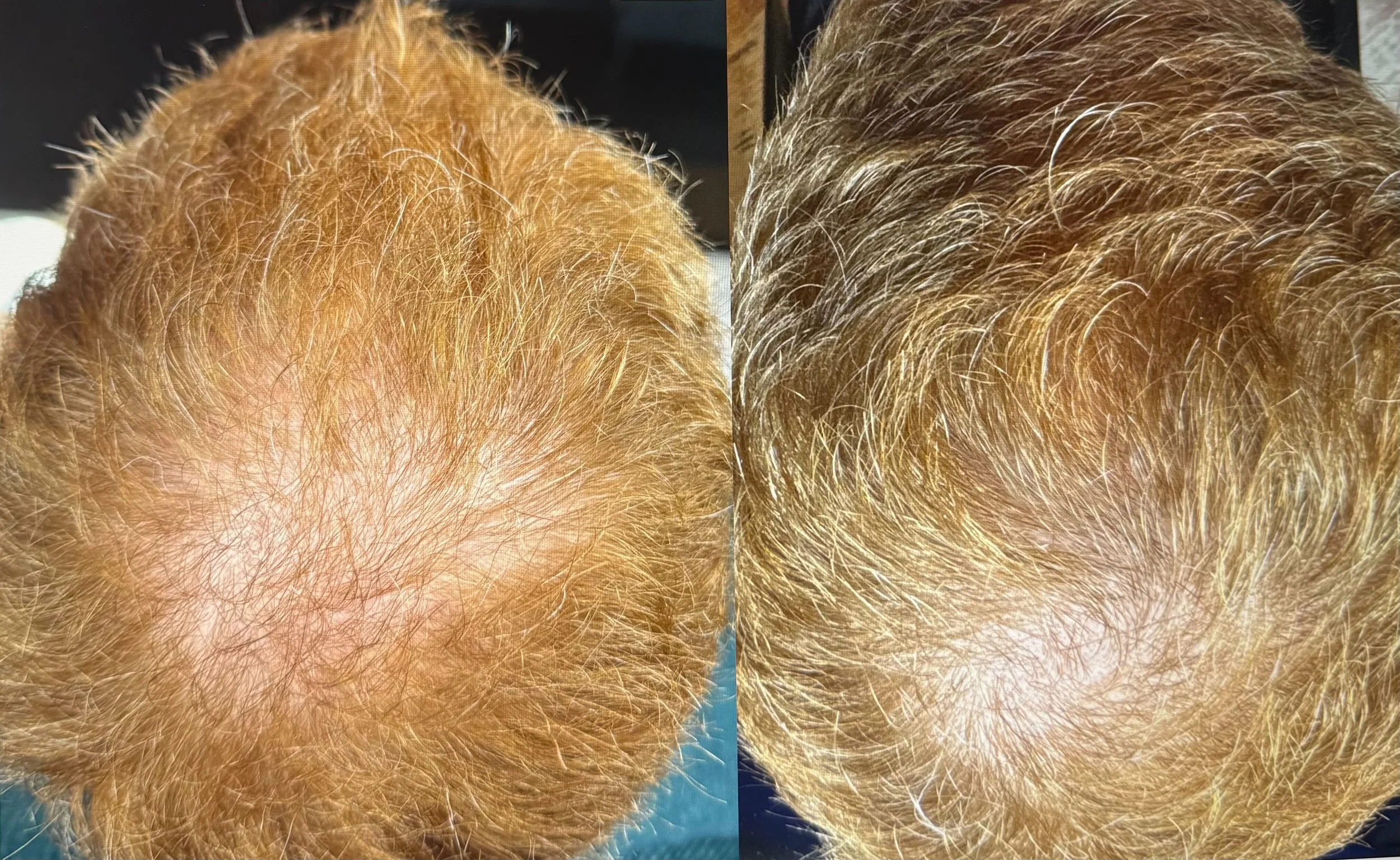 Back of man's head to show hair growth progress with the results on the right showing fullness at the center