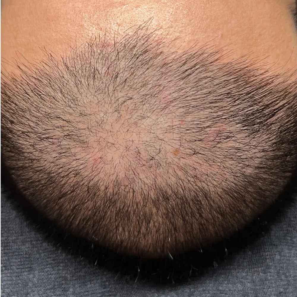 Before men's hair loss treatment at The Vancouver Aesthetician — visible thinning hairline and slow hair growth on man's scalp