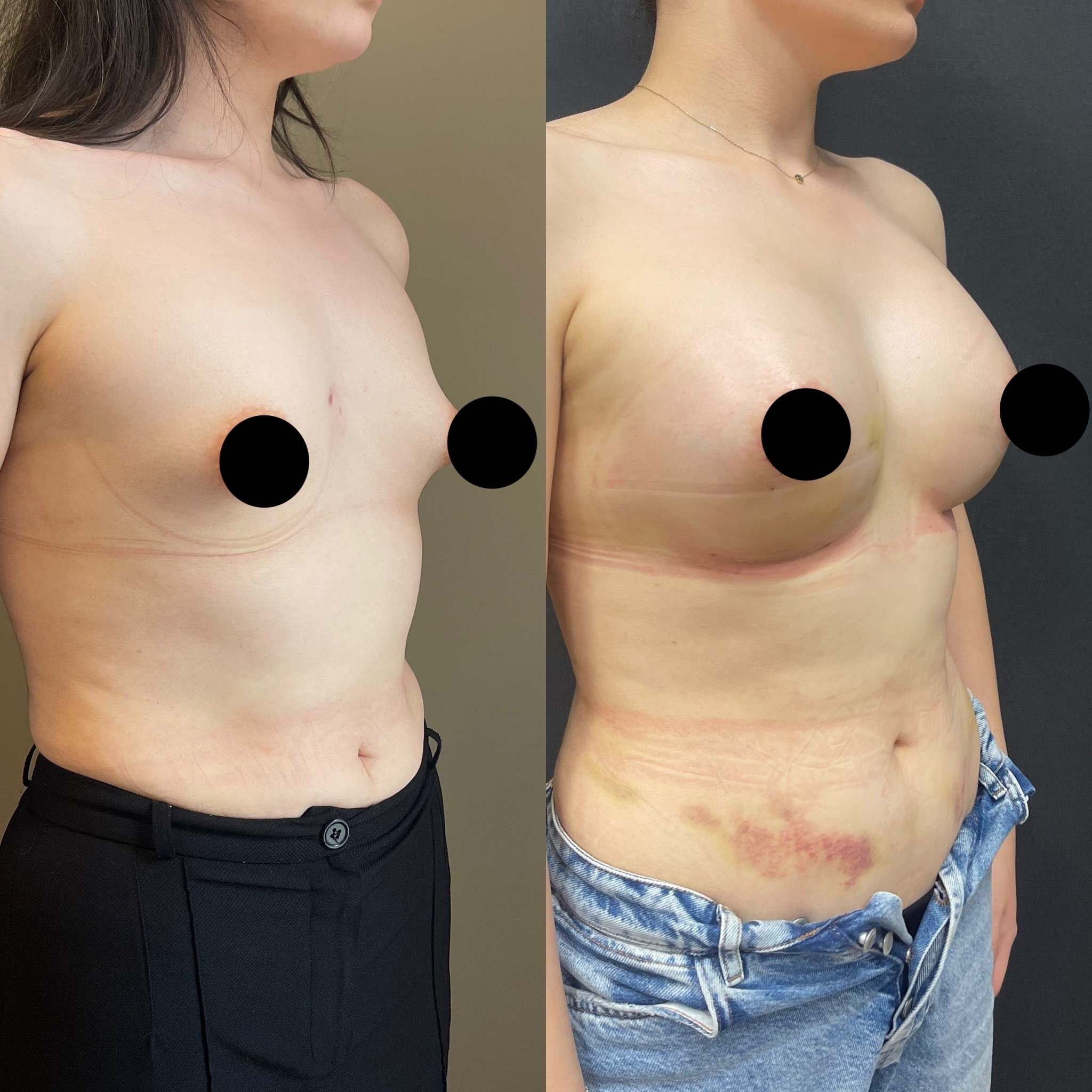 tuberous breast correction before after left oblique view 5 days