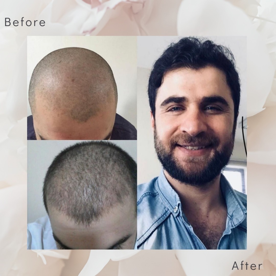 hair transplant