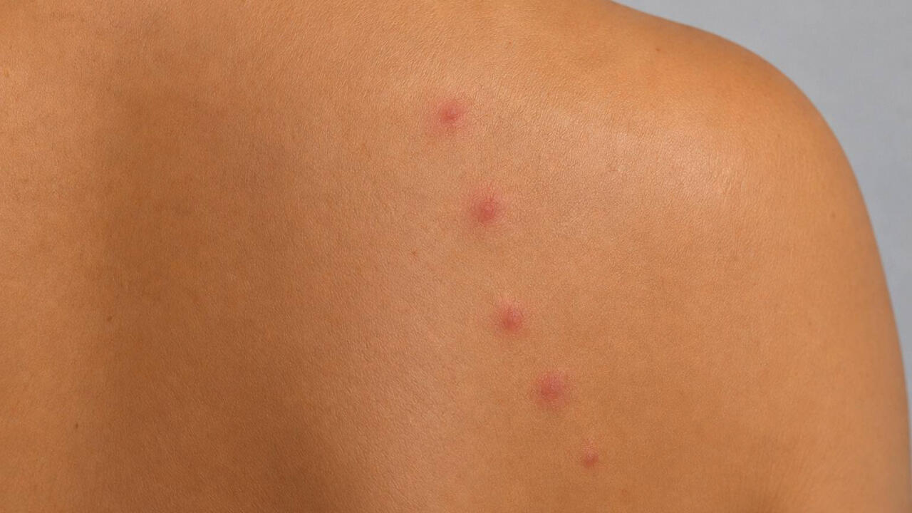 Piqûres de punaise de lit alignées sur l'épaule, boutons rouges caractéristiques