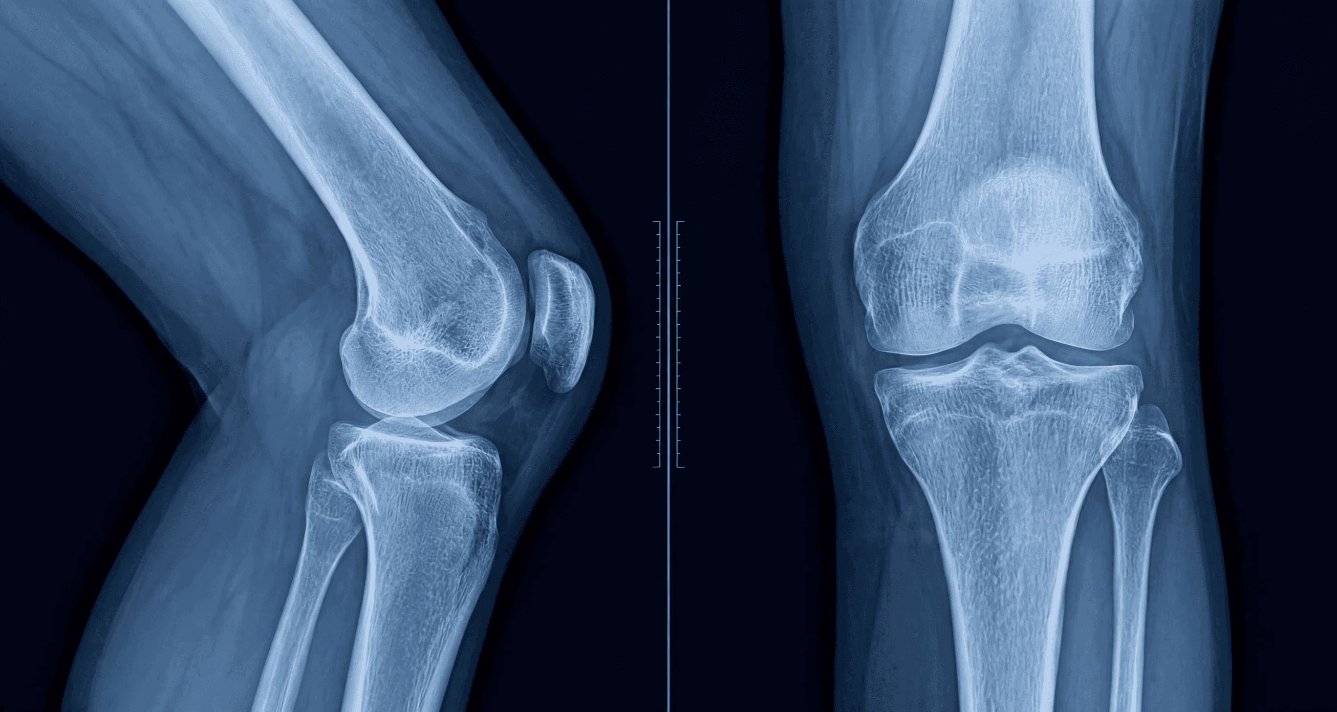 X-ray image of a human knee joint on a dark blue field, featuring caption text introducing "AgAIN Silver" sourced from reclaimed medical X-ray films.