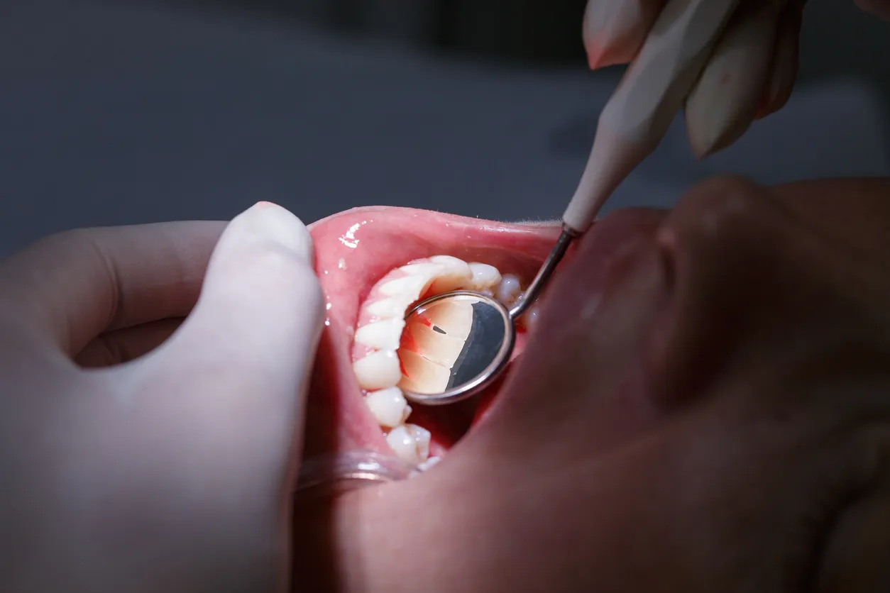Dental Filling