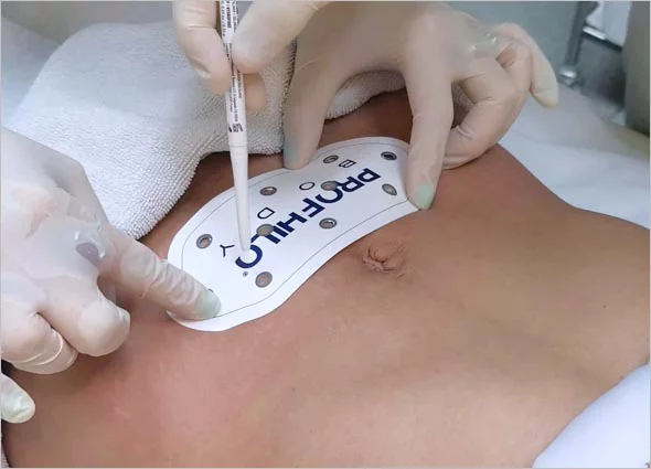 Profhilo body en Terrassa, Barcelona. En Heaven Clinics