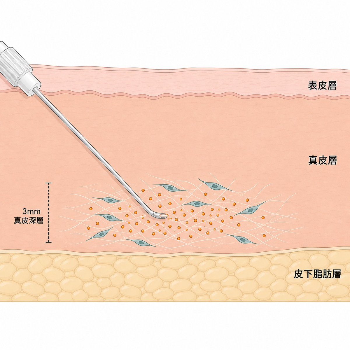 聚左旋乳酸微粒停留在真皮深層，纖維母細胞逐步生成新的膠原蛋白纖維