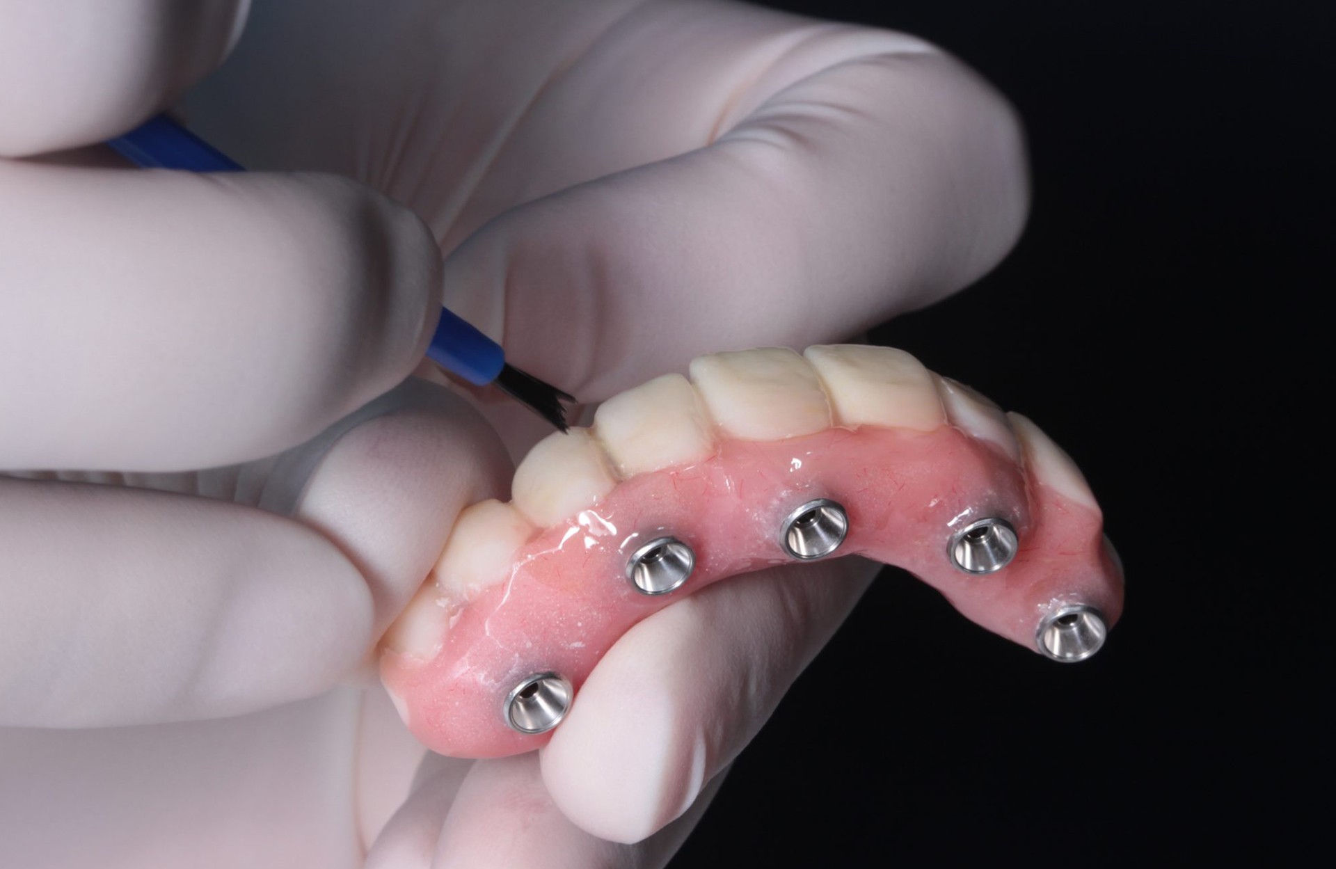 Multiple Dental Implants