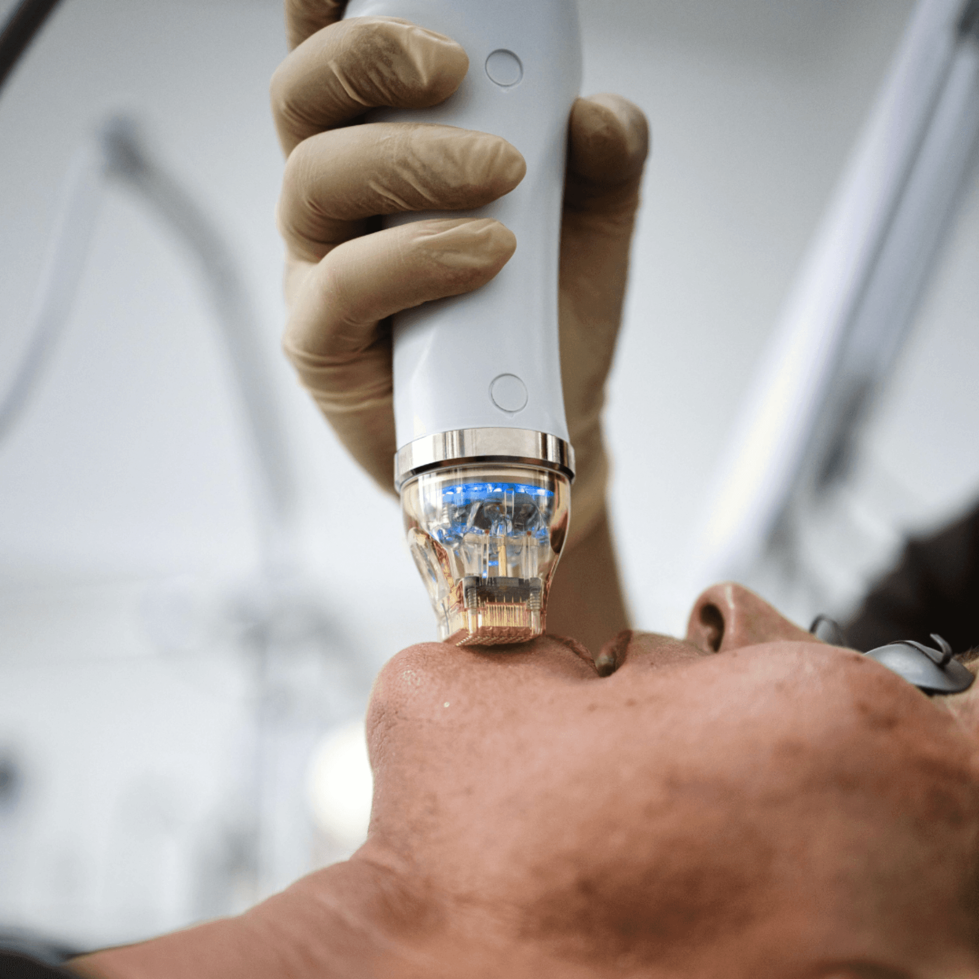 Microneedling RF – Activa Heilbronn