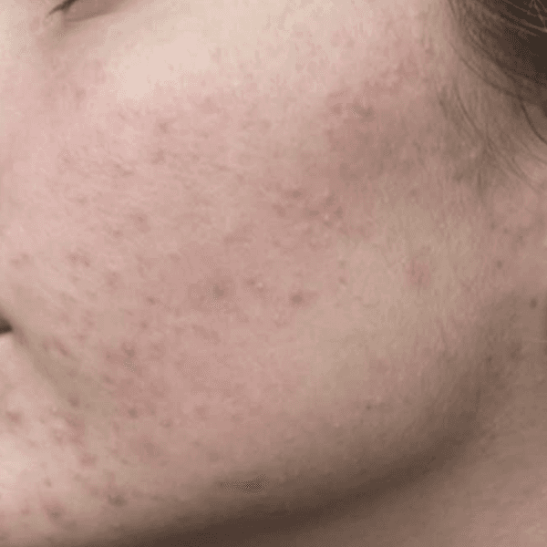 Clear + Brilliant Before