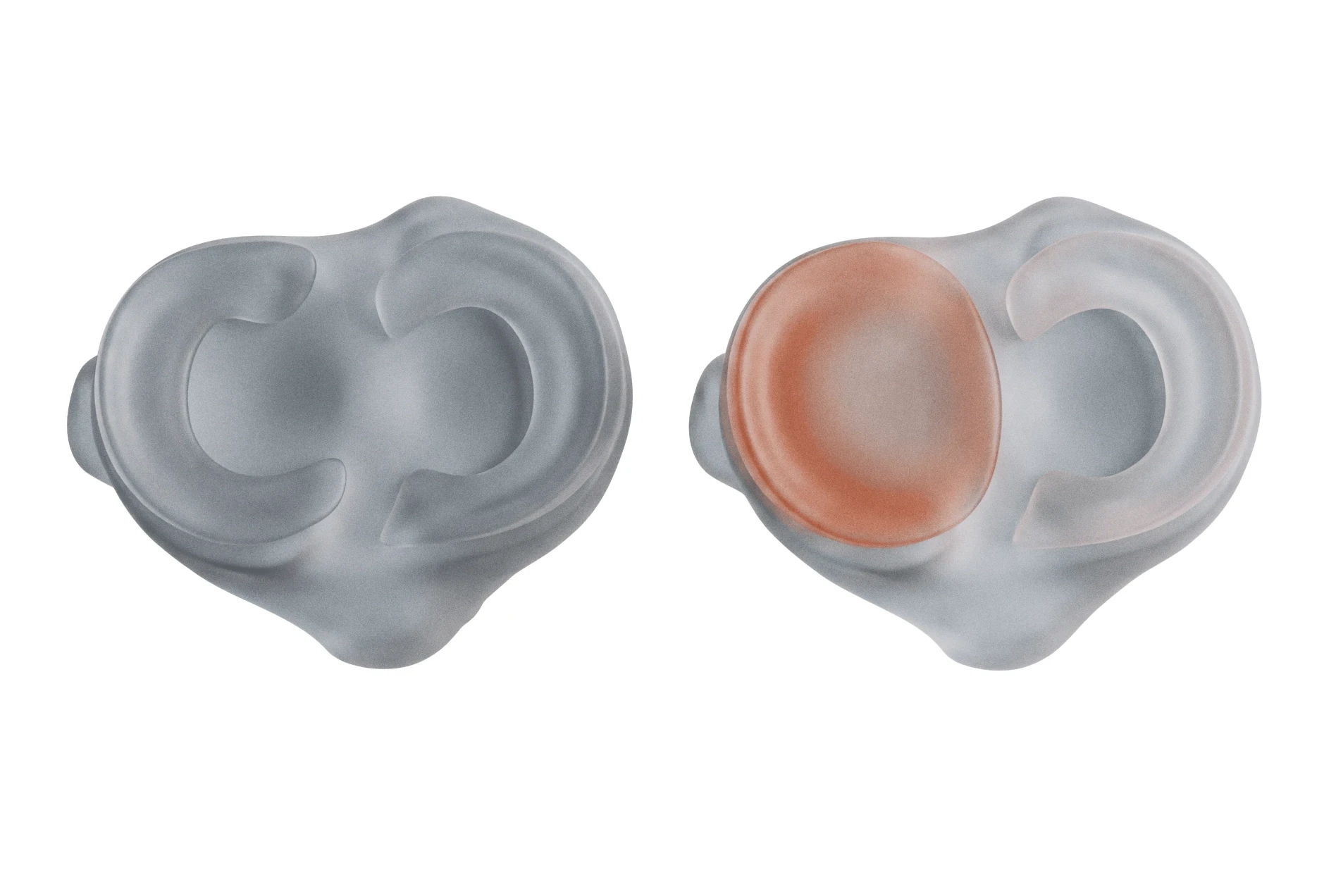 Child Discoid Meniscus