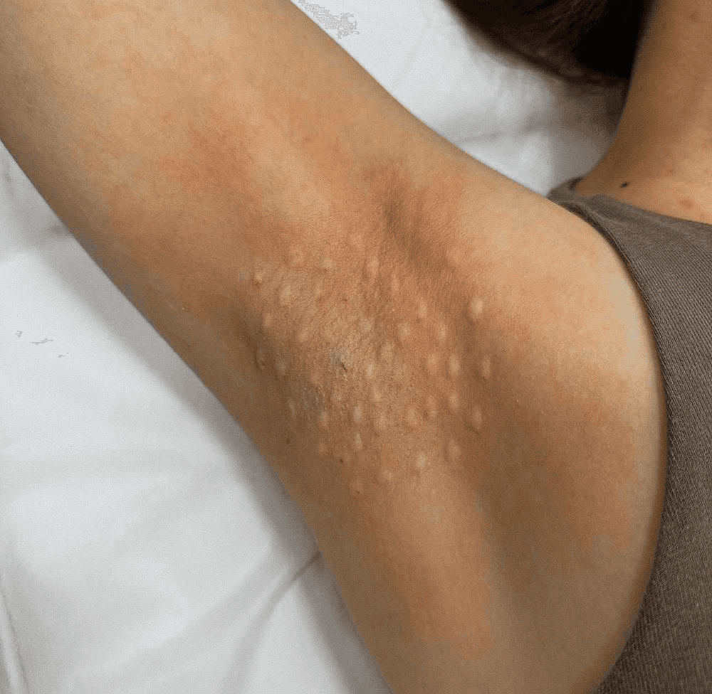 Tratamiento de hiperhidrosis en Terrassa, Barcelona. En Heaven Clinics