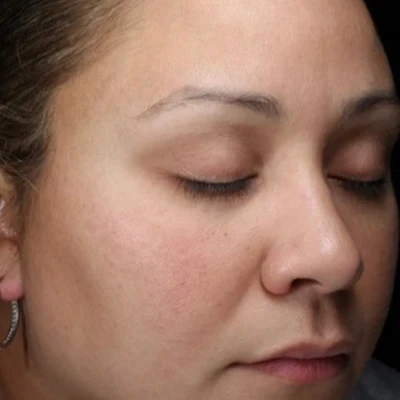 After soothing anti-inflammatory treatment at The Vancouver Aesthetician — sensitive skin redness visibly reduced and skin barrier noticeably calmed and strengthened
