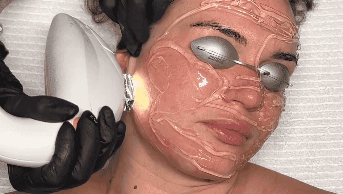 IPL Photofacial to pair with  microneedling