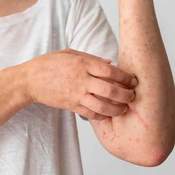 La Roche Posay para remediar piel atópica en Mutilkva