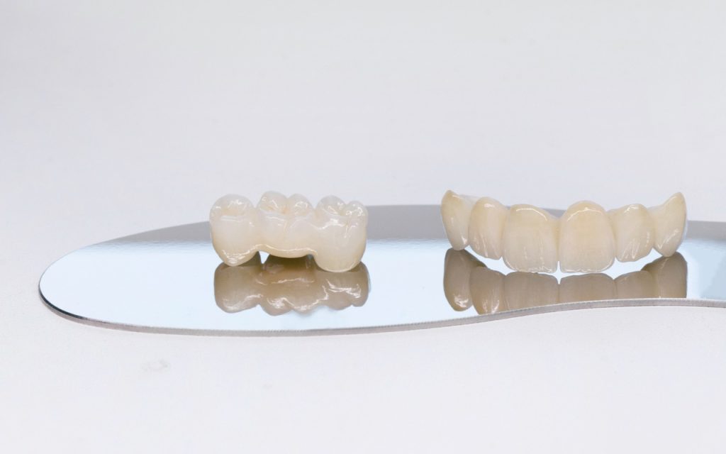 dental bridges