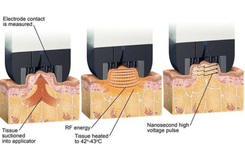 Diagram of radiofrequency skin treatment
