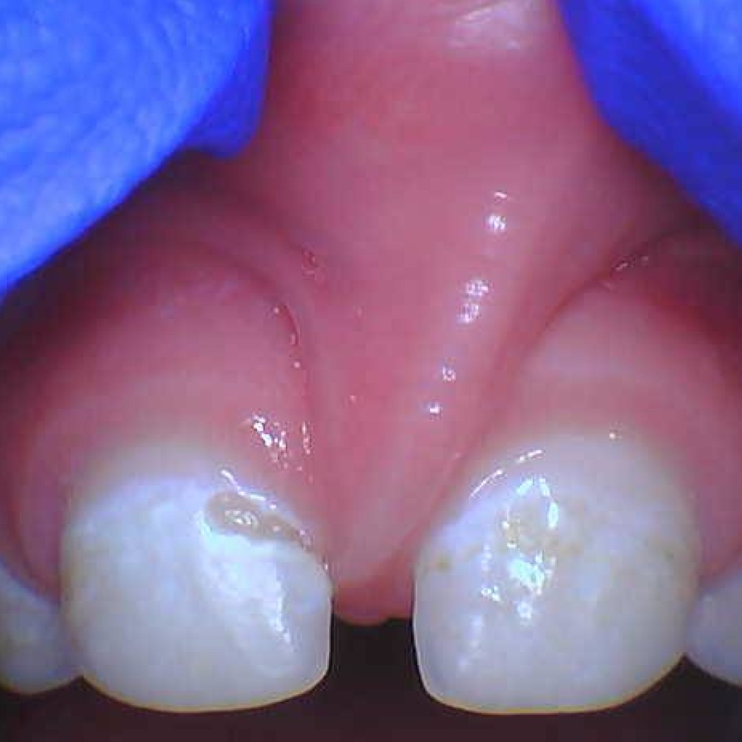 Close-up clinical image of a child or teen’s upper lip tie before frenectomy, with gloved hands gently lifting the lip to show the tight frenulum.