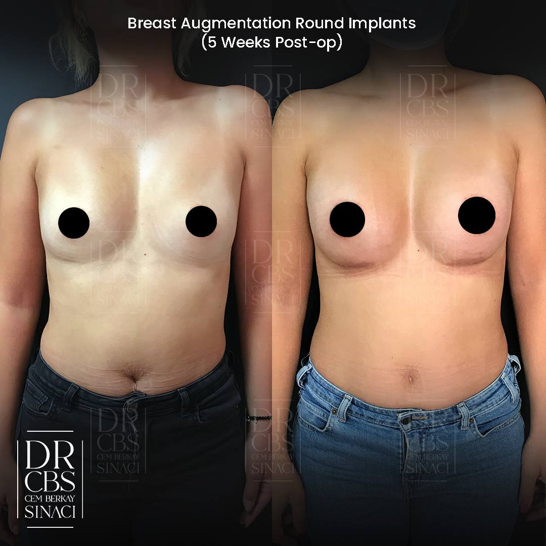 2 weeks, breast implant before after front view