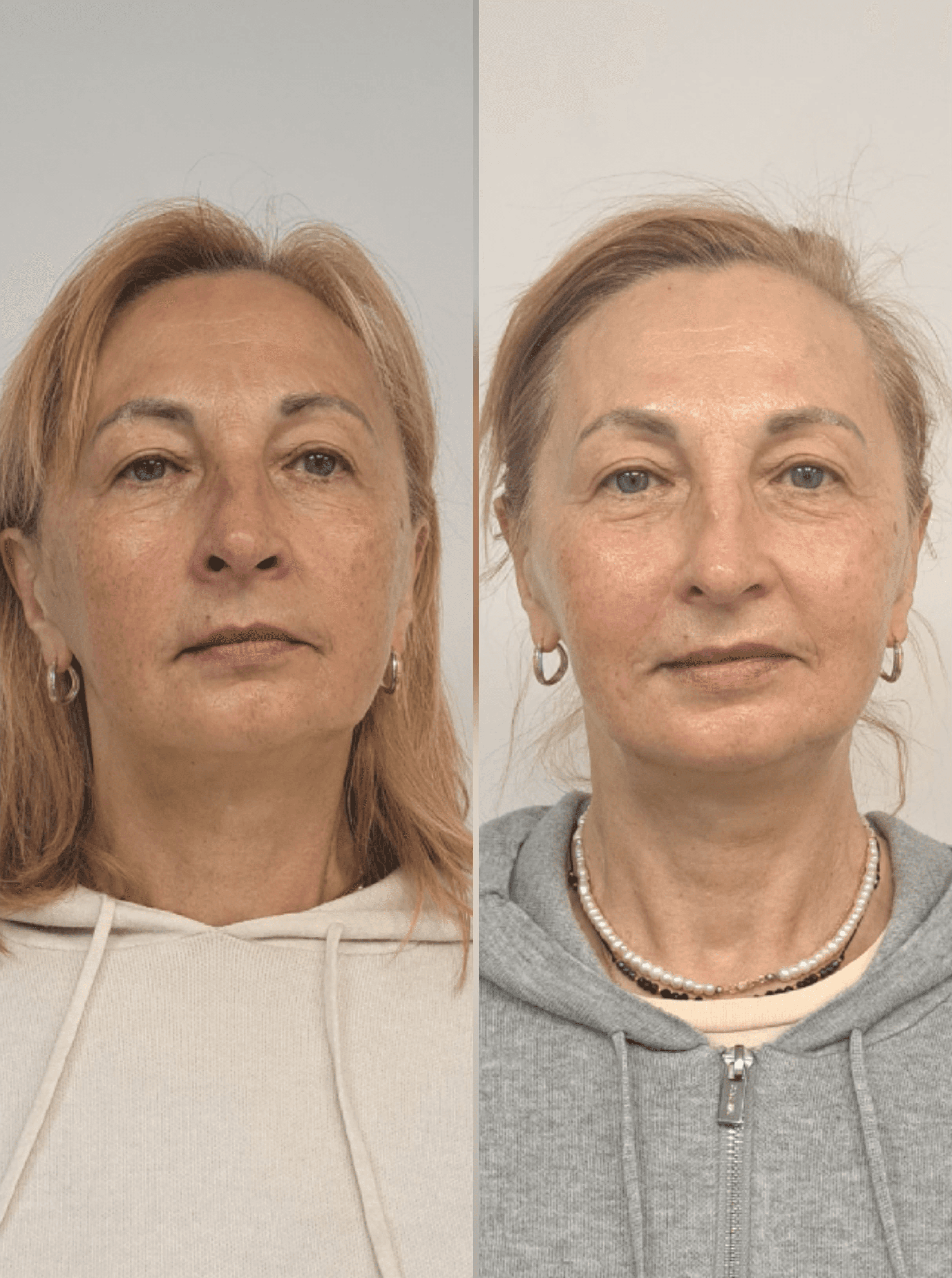 Neurolifting leszczenko_estGen_naturalny_lifting_bez_skalpela_szczecin_wrocÅaw_non_ivasive_lift_riyadh