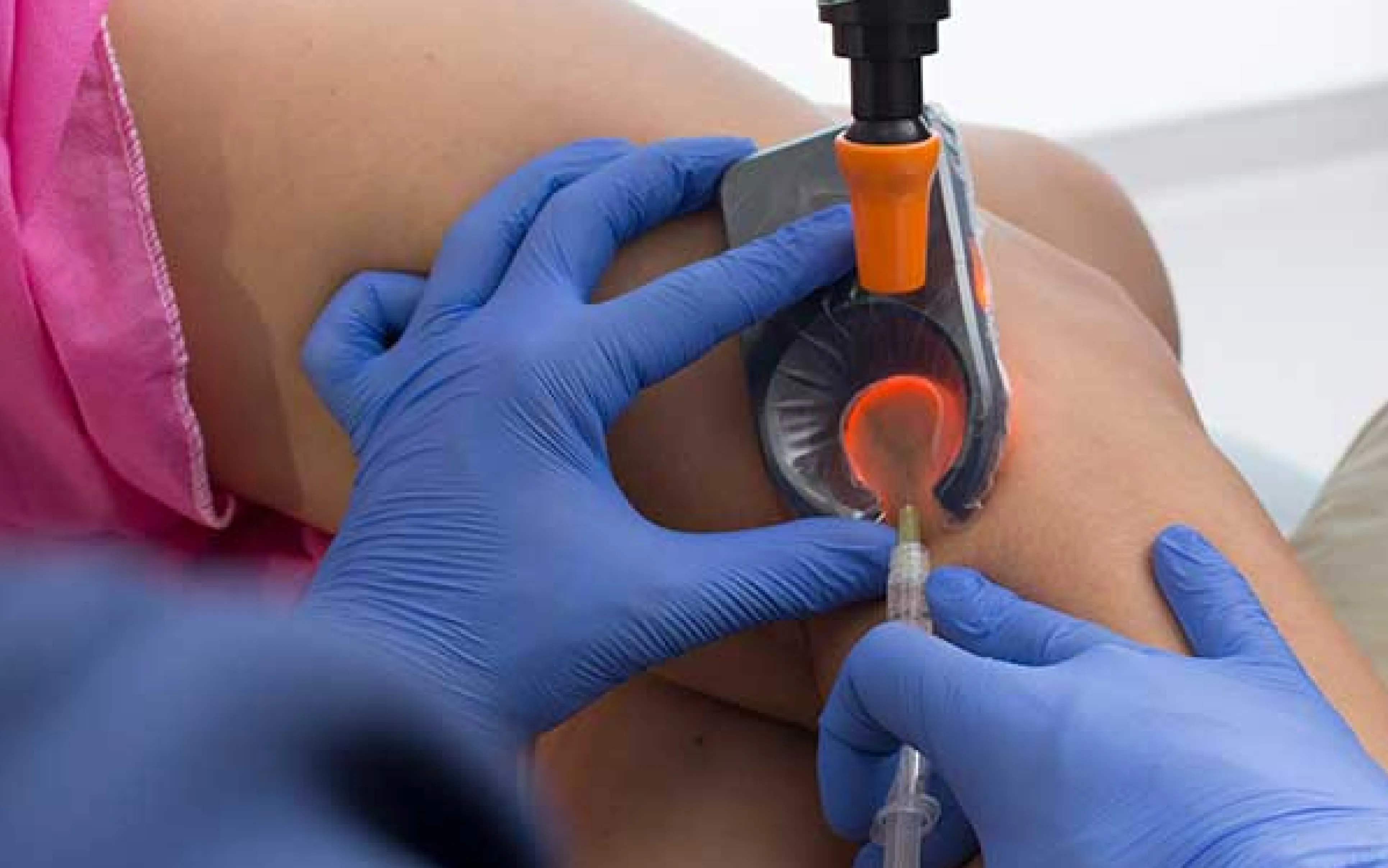 Procedimento de escleroterapia líquida para tratar vasinhos