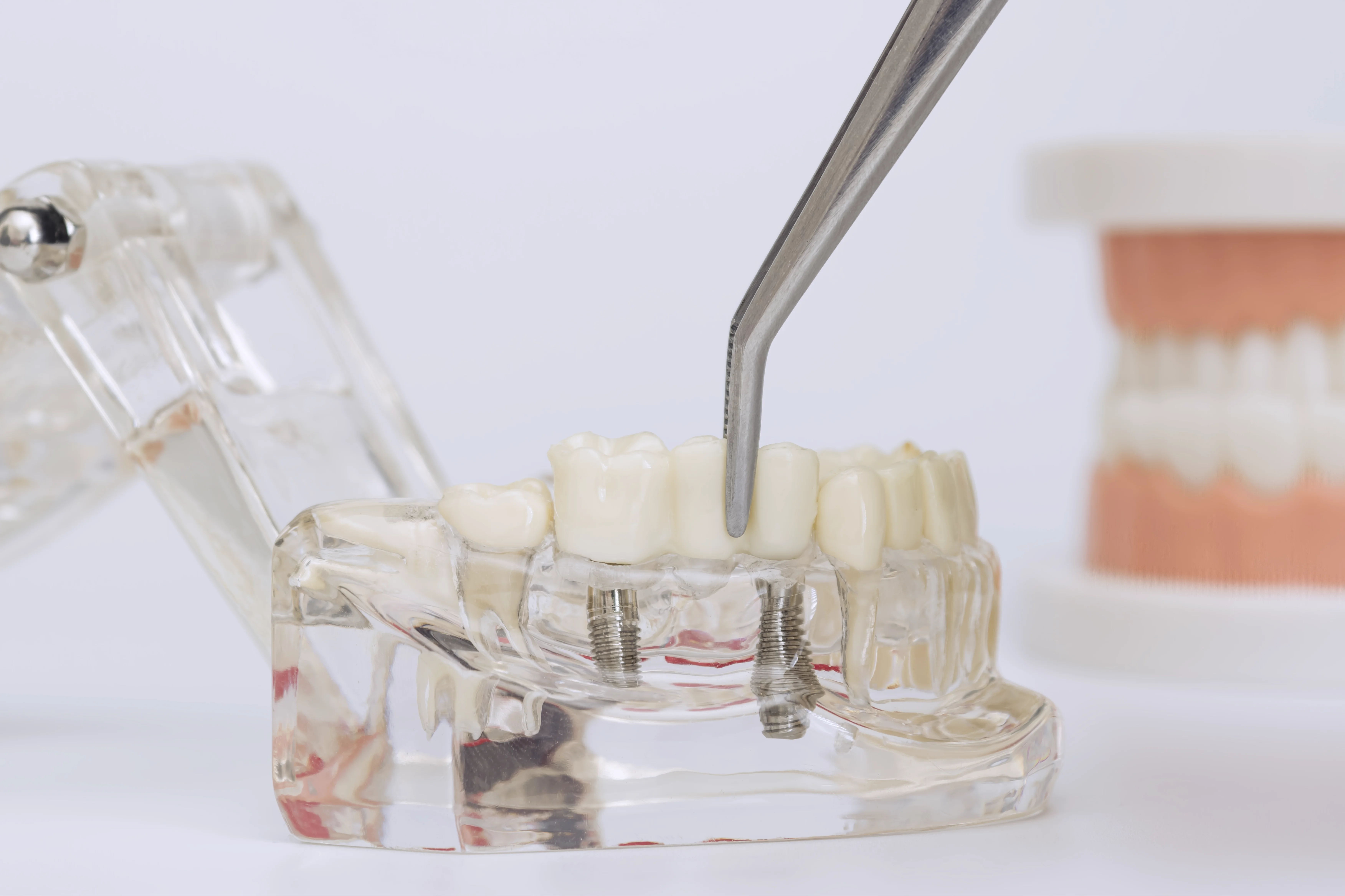Implantatbehandling på tandmodell