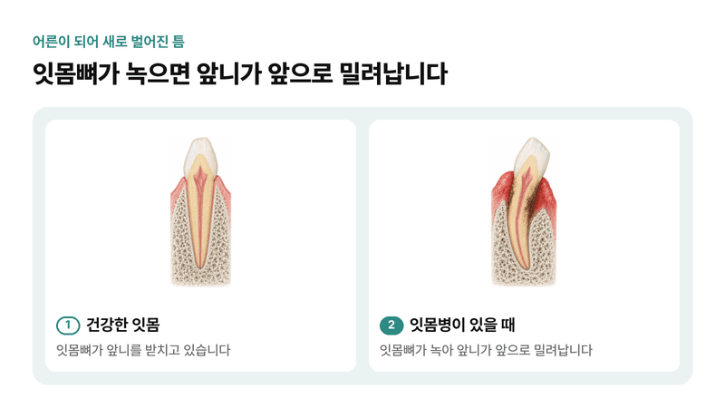 잇몸병으로 잇몸뼈가 내려가 앞니가 앞으로 밀려나며 앞니 사이에 틈이 새로 생기는 과정을 건강한 잇몸과 비교한 일러스트