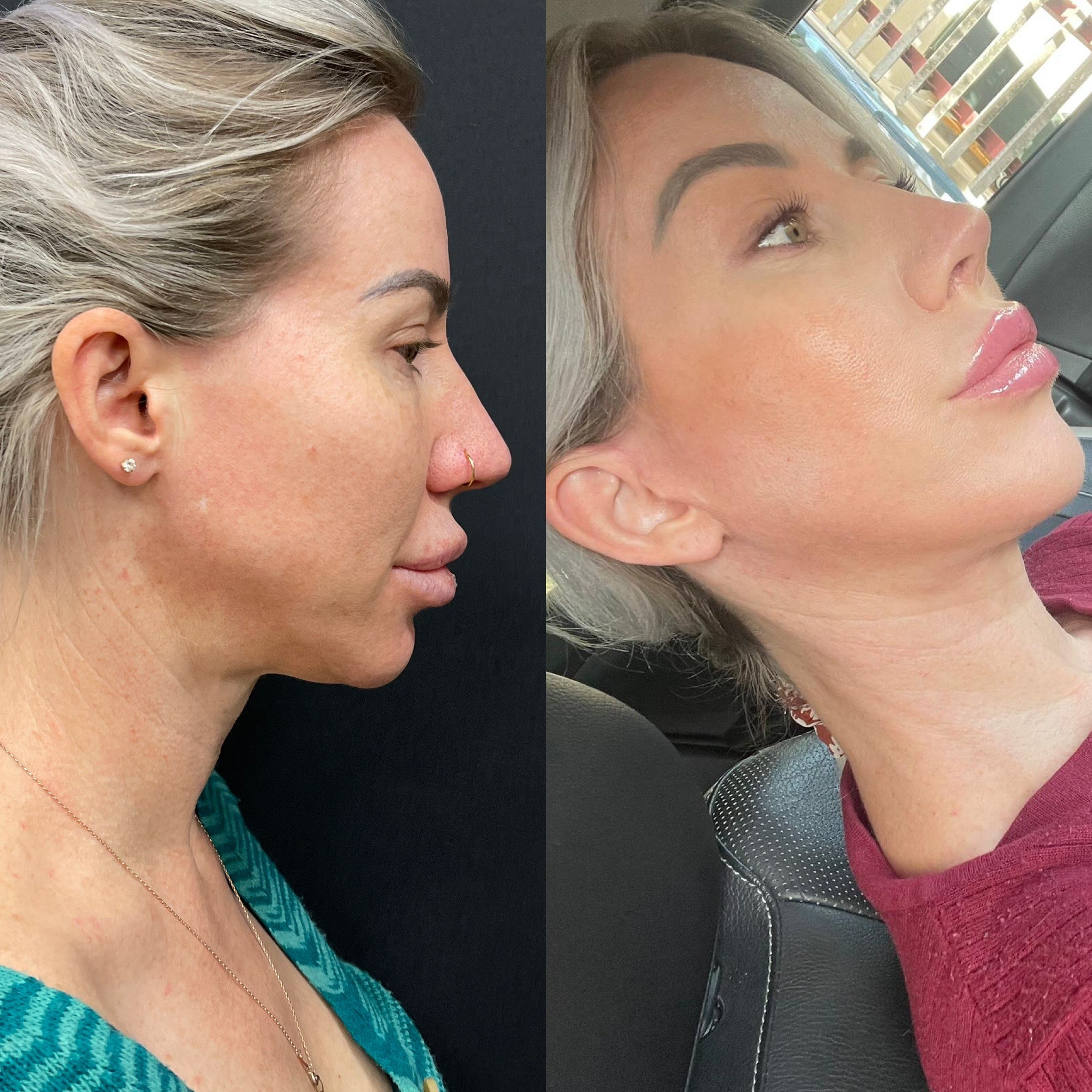 1 month post op deep plane short scar facelift