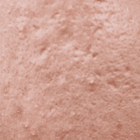 여드름 흉터 파이고 튀어나온 굴곡을 완화 시키기 |  홍대 뷰티스톤 합정피부과