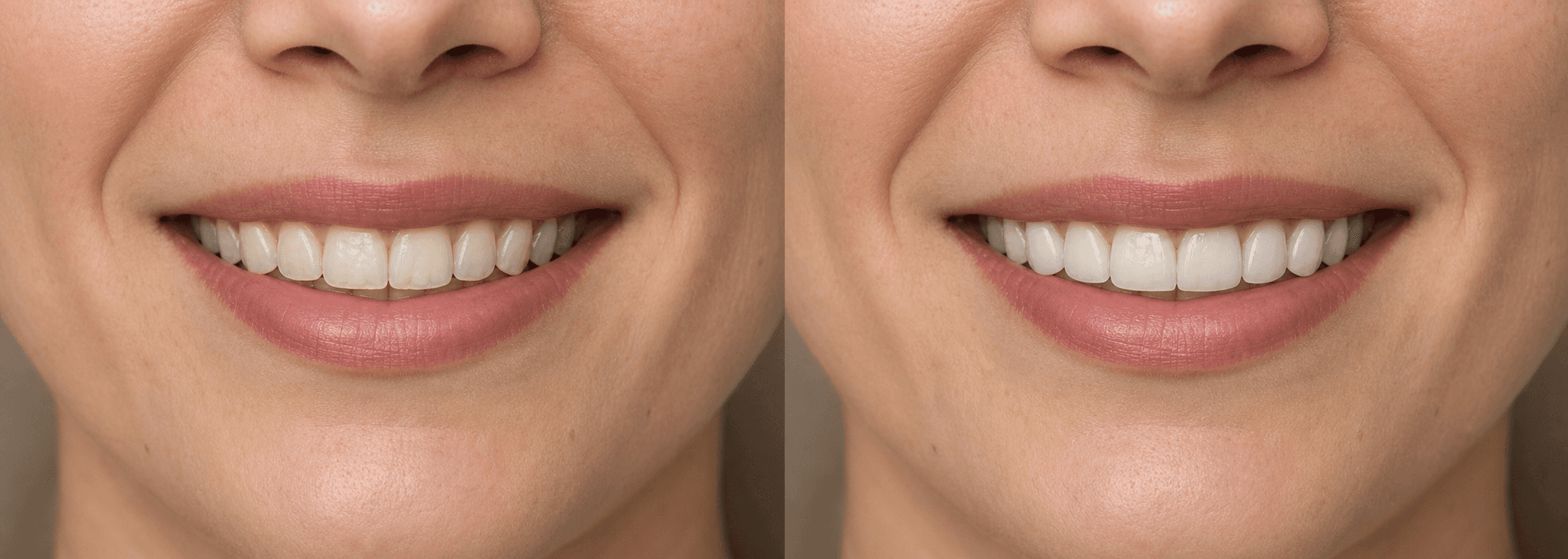 Smile after cosmetic treatment