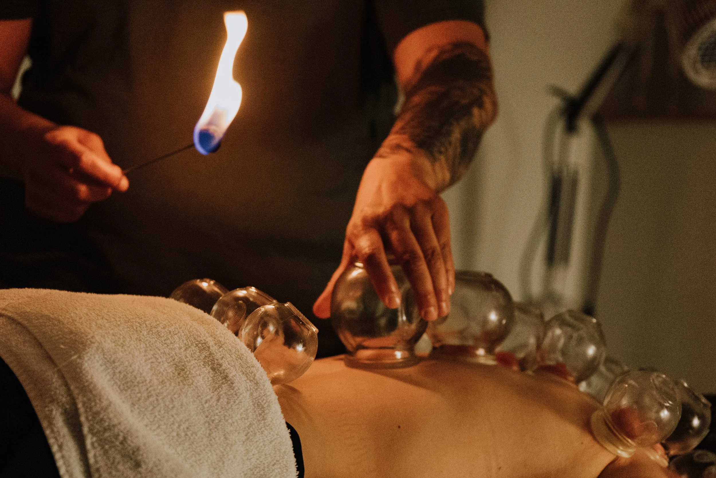 * cupping therapy on back treatment