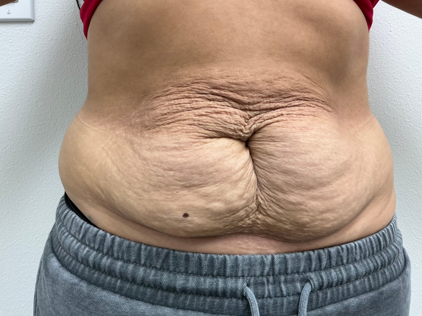 RF microneedling · Abdomen: before treatment