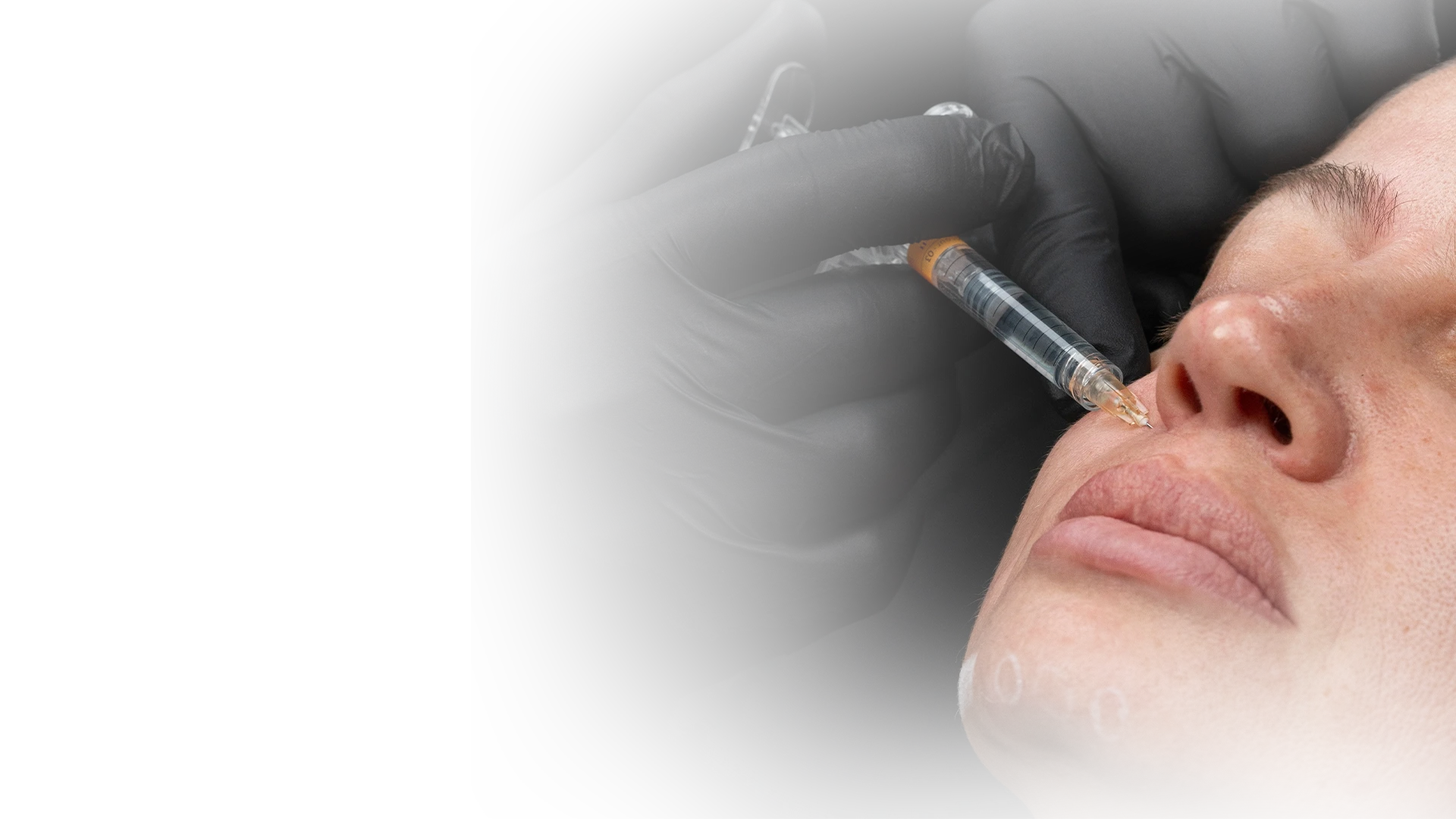 Close-up dramático de um procedimento estético de harmonização facial onde um profissional com luvas pretas aplica uma injeção de preenchedor dérmico na região da bochecha de uma paciente com olhos fechados. Fundo preto focal.
