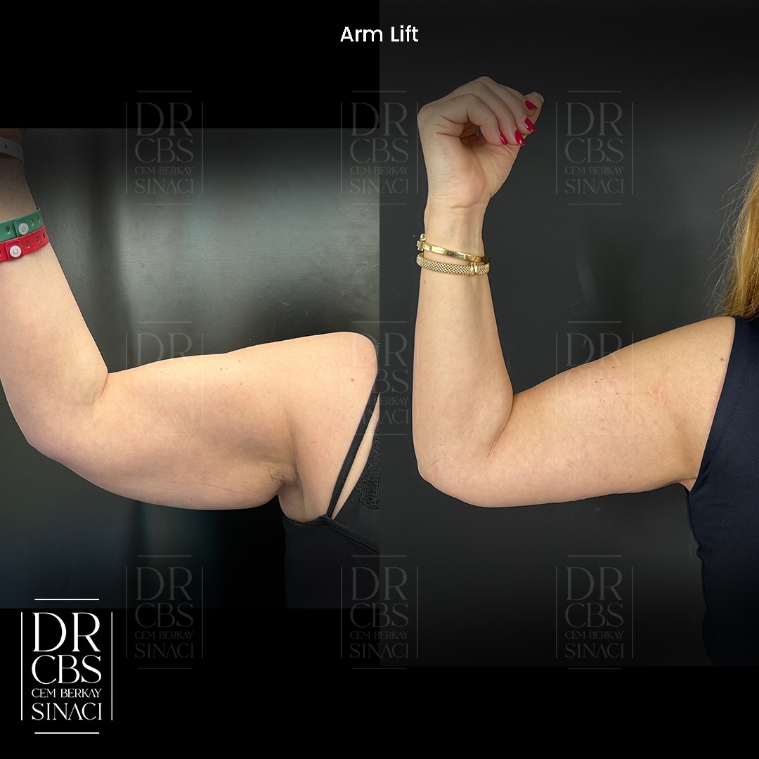 before after arm lift 2 months post-op right arm front view