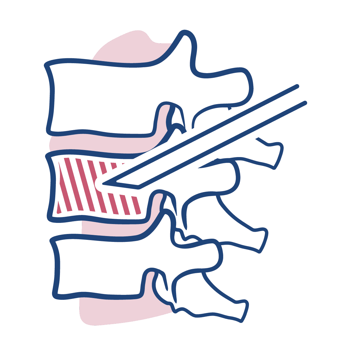 Desenho ilustra vértebras em traços azuis, com uma agulha de seringa injetando na parte interna da vértebra, respresentando a vertebroplastia.