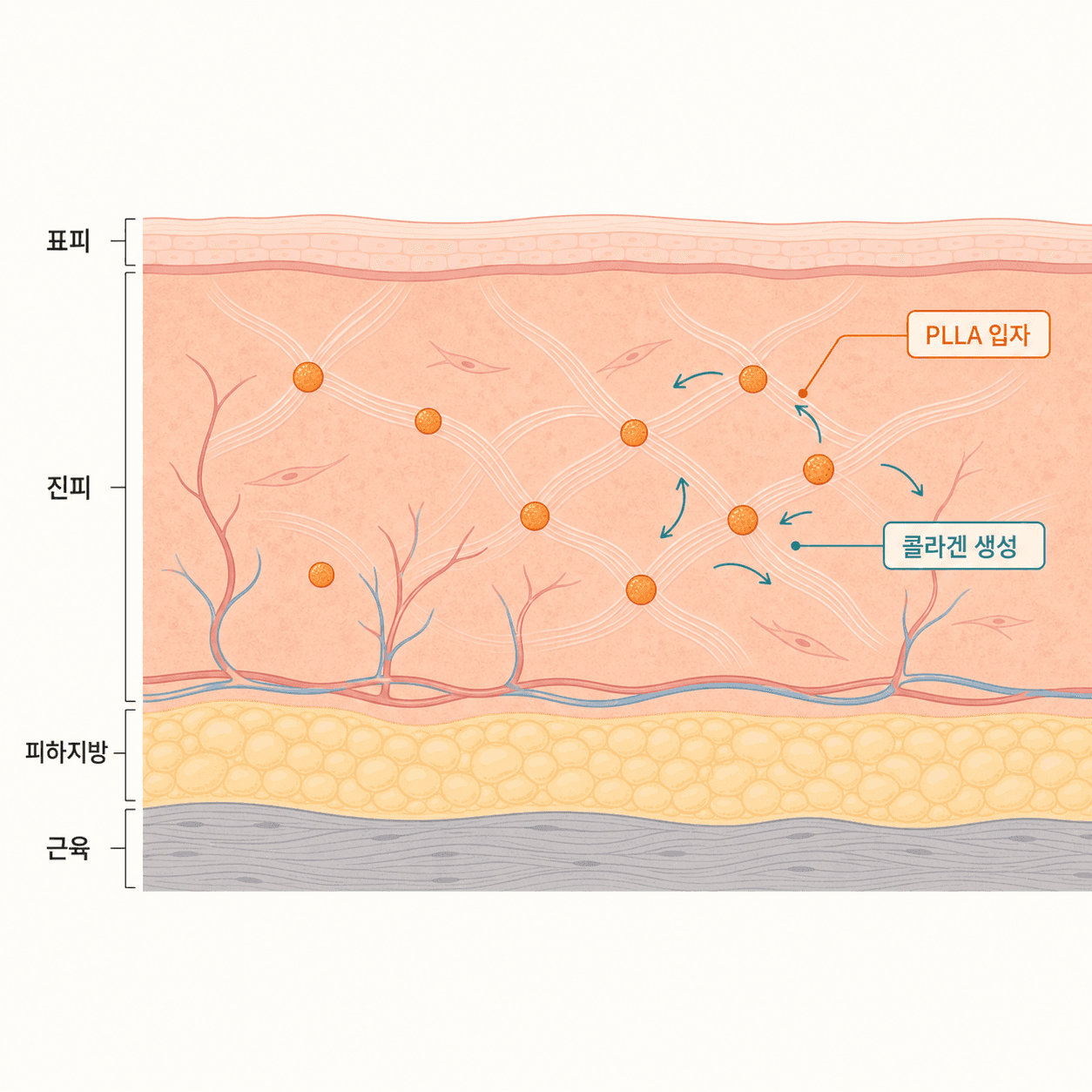 목·데콜테 피부층과 진피 내 PLLA 입자 주변 콜라겐 생성 과정