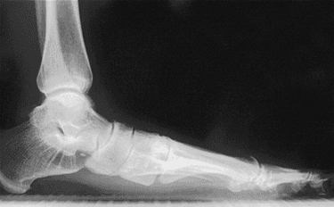 X-ray of Posterior Tibial Tendon Dysfunction