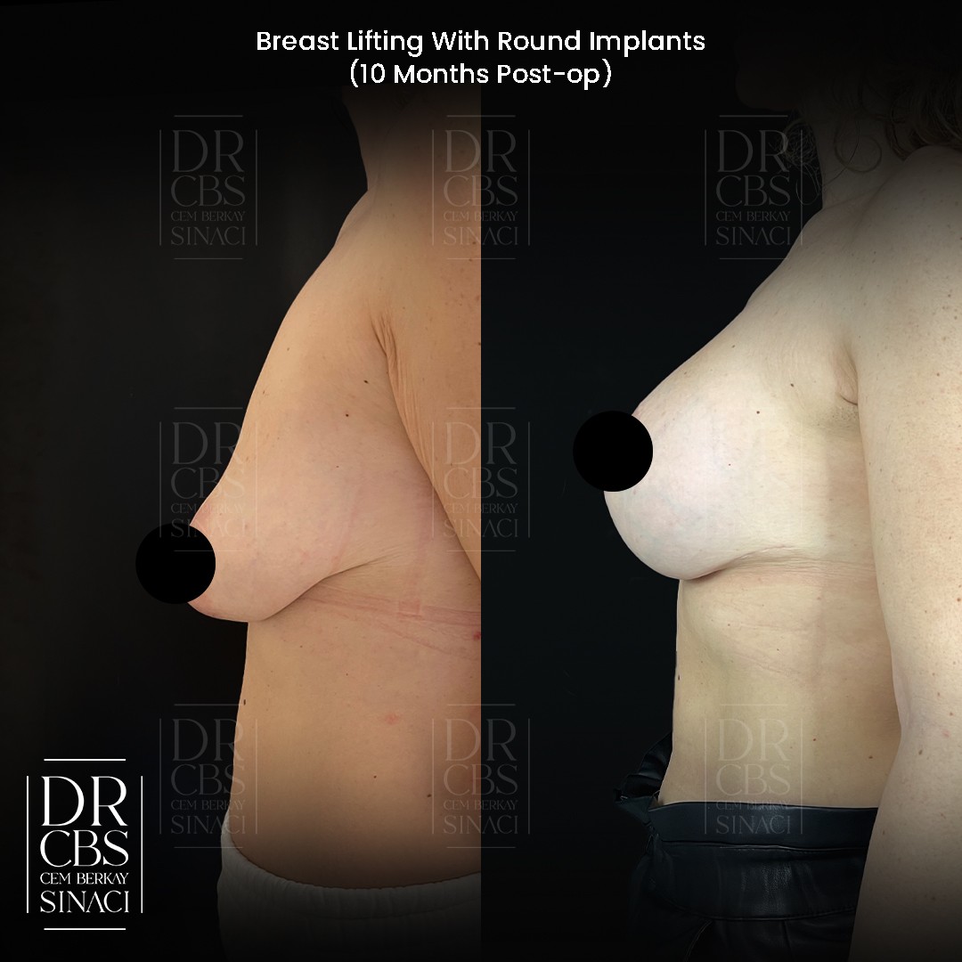 10 months before after breast lift with implant in Istanbul Turkey side view