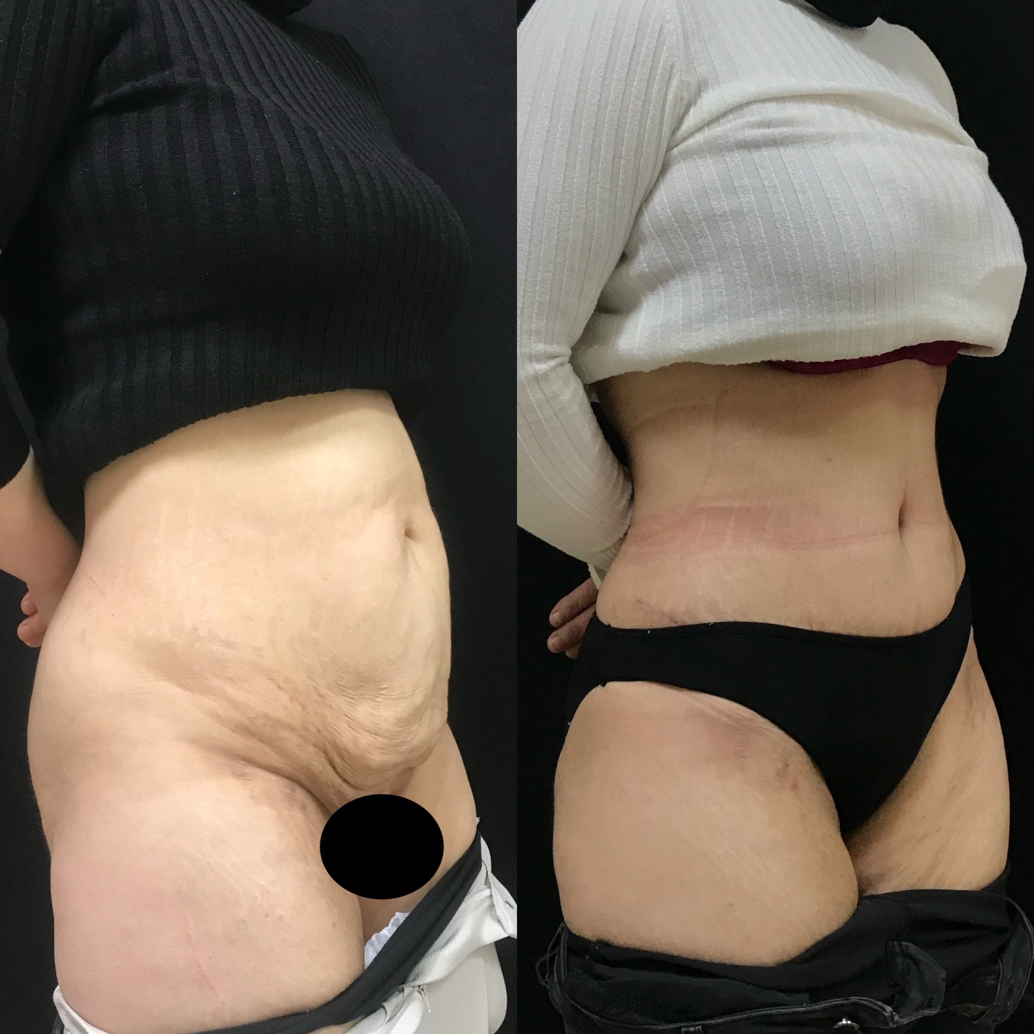 tummy tuck and liposuction before after result Istanbul, Turkey oblique view