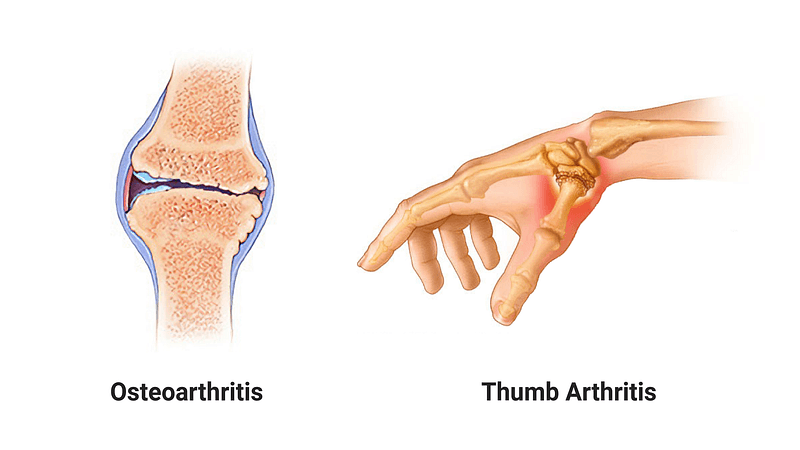 Osteoarthritis Thumb Arthritis