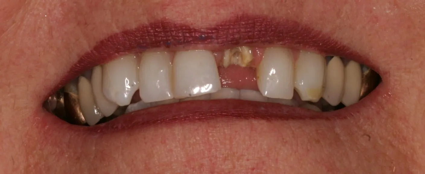 Before: broken tooth and cavity