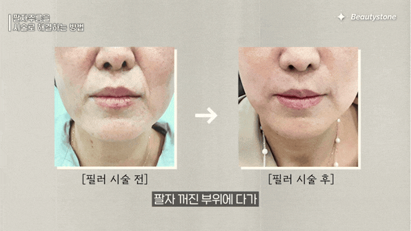 보톡스 대신 쥬베룩? 팔자주름 유형별 시술 가이드