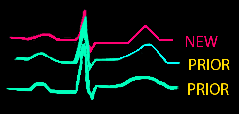 t wave comparison