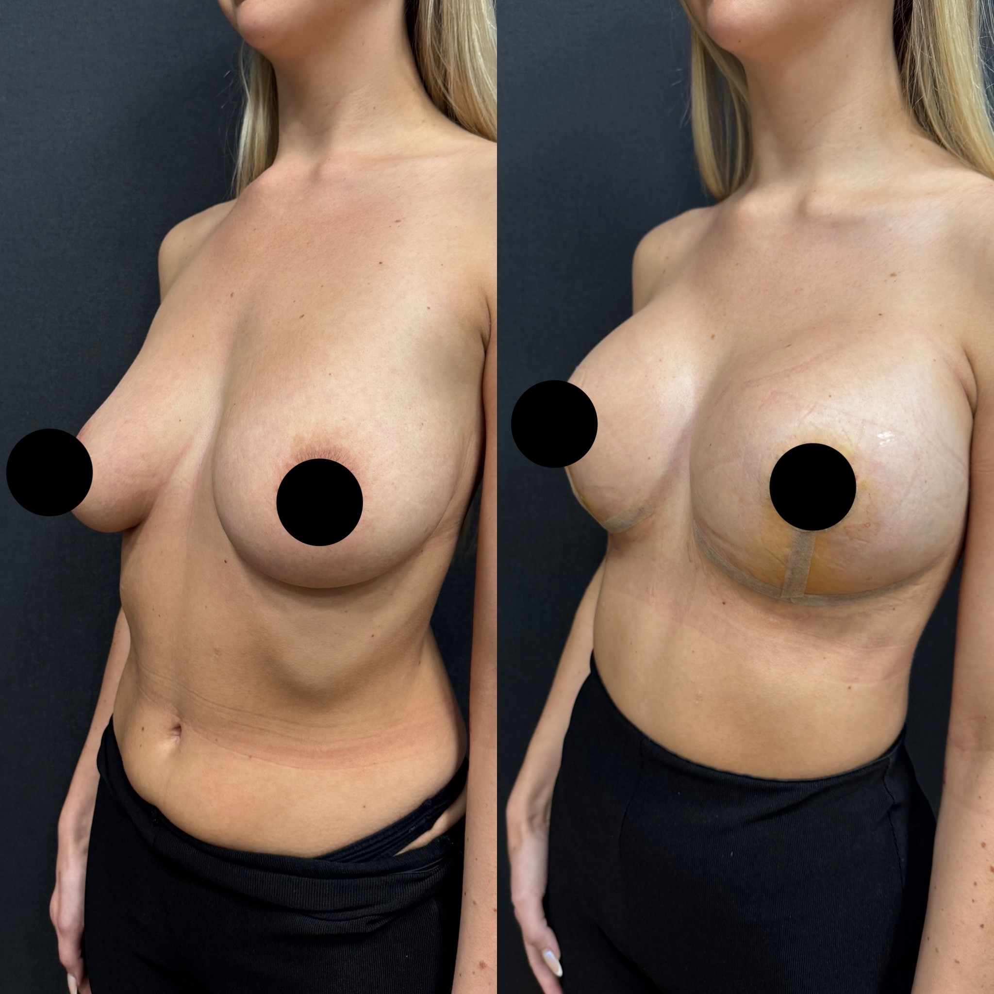 breast lift with implant before after 5 days result left oblique view