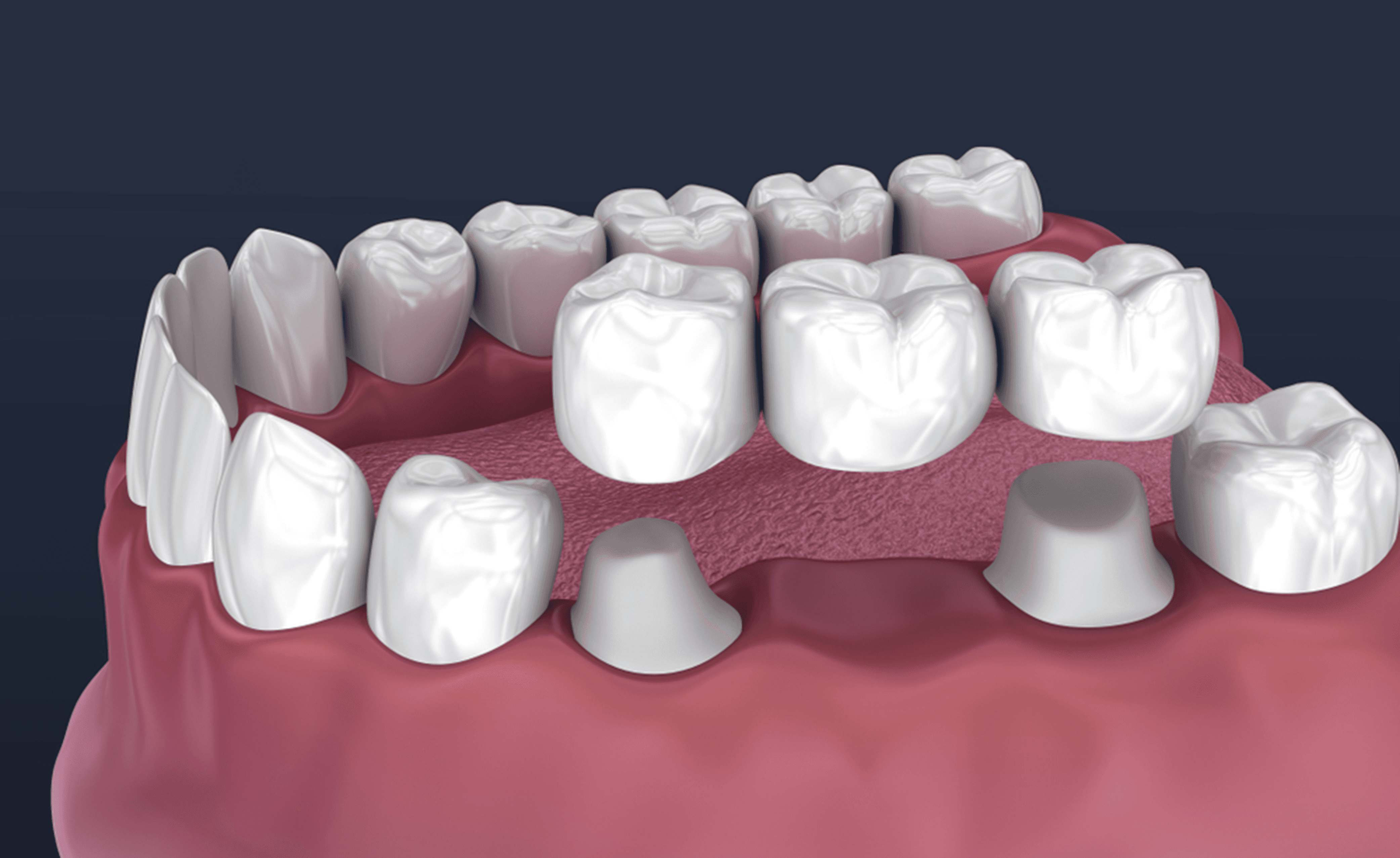 Dental Crown and Bridges