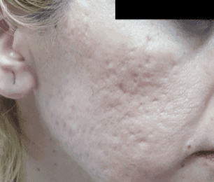 After RF microneedling treatment