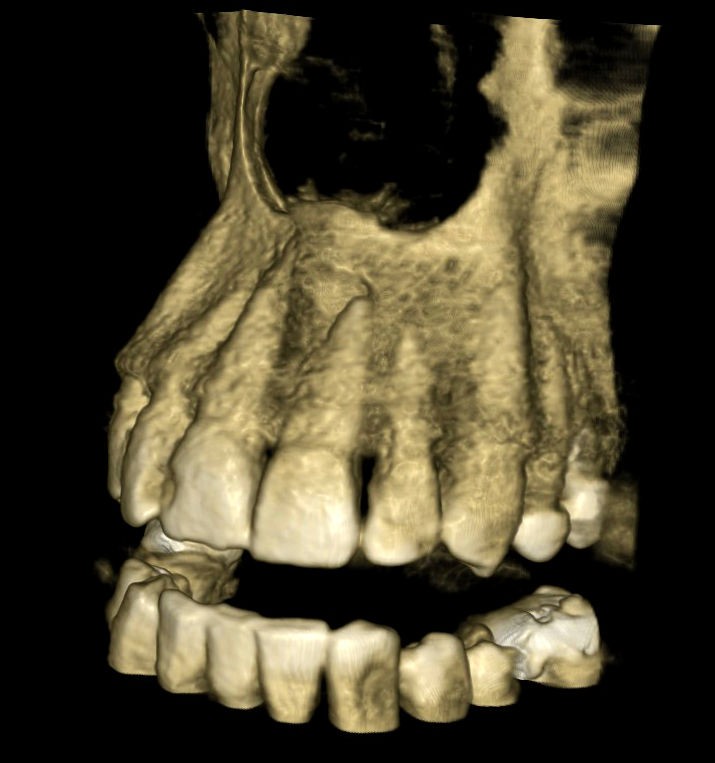 CBCT snímka so zahojenou kosťou a ošetreným koreňovým kanálikom